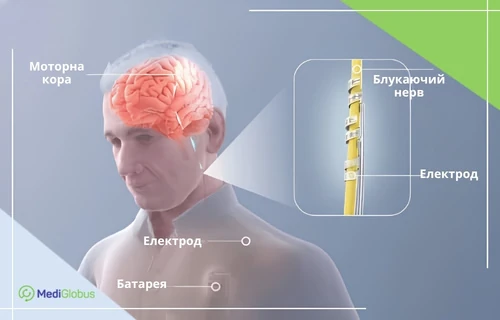 схема VNS-терапії — електрод на блукаючому нерві та імплант у грудній ділянці для стимуляції мозку