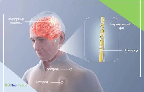 схема VNS-терапии — электрод на блуждающем нерве и имплант в грудной области для стимуляции мозга