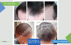 Пересадка волос в клинике Istanbul Aesthetic