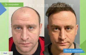 Пересадка волос в клинике Turkey Hair Academy
