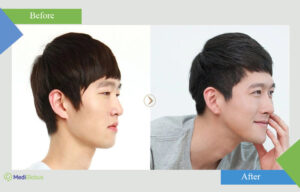 kim sung sik rhinoplasty before after photo