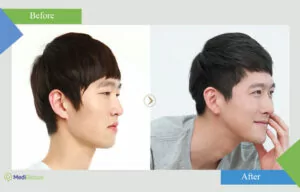 kim sung sik rhinoplasty before after photo