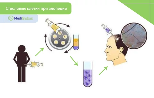 Как могут помочь стволовые клетки при выпадении волос?