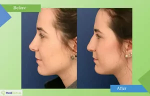 vicente paloma mora rhinoplasty before after photo
