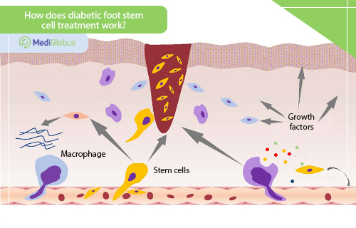 stem cell diabetic foot treatment
