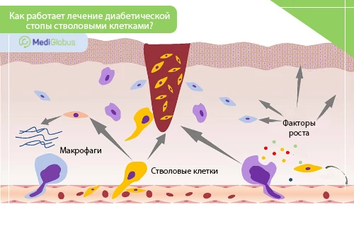 можно ли вылечить диабетическую стопу