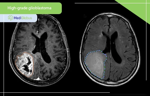 high grade glioblastoma mri