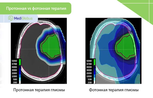 сравнение фотонной и протонной терапии