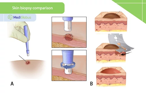 skin biopsy types