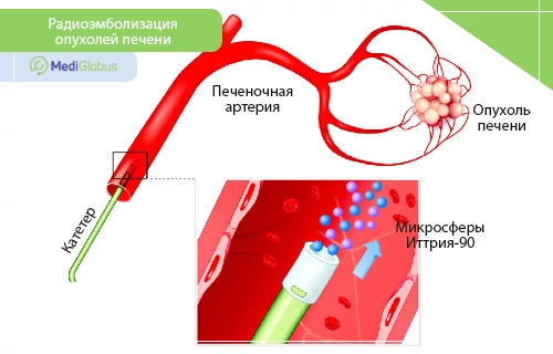 современные методы лечения рака печени микросферы иттрия 90