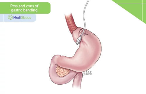 pros and cons of gastric banding