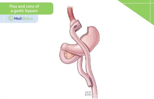 pros and cos of a gastric bypass