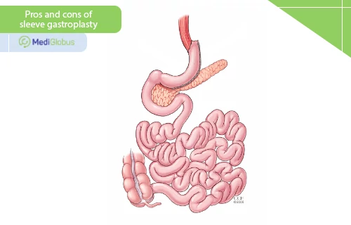 pros and cons of sleeve gastroplasty