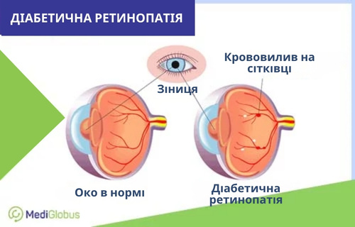 Ретинопатія у хворих на діабет — що це таке і як її лікувати? Порівняння здорового ока та ока зі змінами при діабетичній ретинопатії: ліворуч показано око в нормі зі стабільними судинами сітківки, праворуч видно дрібні червоні цятки, що символізують крововиливи та мікроаневризми на сітківці внаслідок ураження судин.