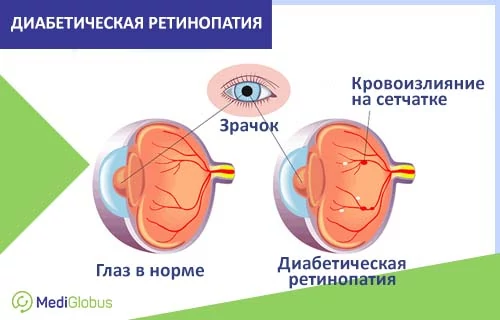 Ретинопатия у диабетиков - что это и как лечить? Сравнение здорового глаза и глаза с изменениями при диабетической ретинопатии: слева показан глаз в норме со стабильными сосудами сетчатки, справа видны мелкие красные пятнышки, символизирующие кровоизлияния и микроаневризмы на сетчатке вследствие поражения сосудов.