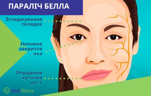 Інфографіка: Симптоми паралічу Белла