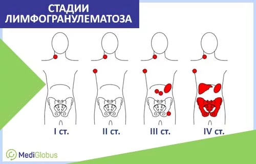Стадии лимфогранулематоза у детей Инфографика: Стадии лимфогранулематоза у детей