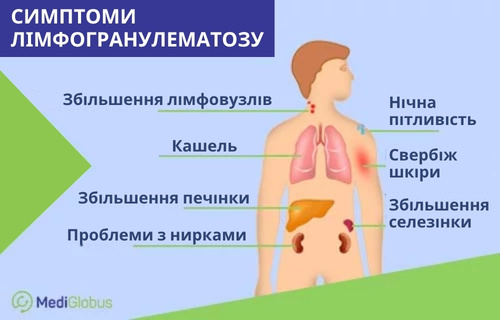Схематичне зображення організму дитини з позначенням симптомів лімфогранулематозу