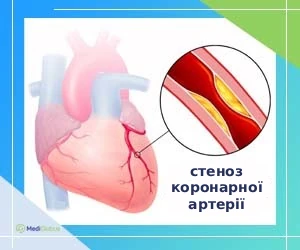 angioplasty_for_arterial_stenosi_ukr Стеноз коронарної артерії серця