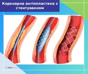 coronary_angioplasty_with_stenti_ukr Як проводиться ангіопластика з стентуванням