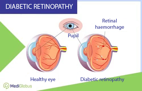 Comparison of current treatments for diabetic retinopathy