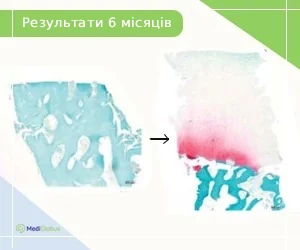 stem-cell-osteoarthritis_ukr Результати лікування остеопорозу стовбуровими клітинами