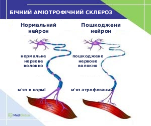 treatment_of_amyotrophic_lateral_ukr Нейрони при бічному аміотрофічному склерозі у порівнянні зі здоровим нейроном