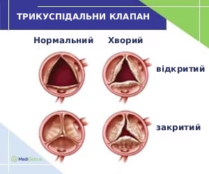 tricuspid_valve_pathology_ukr Як виглядає хворий трикуспідальний клапан