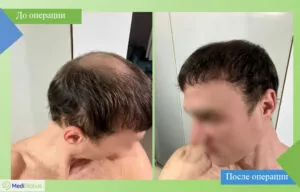 пересадка волос в турции фото до после
