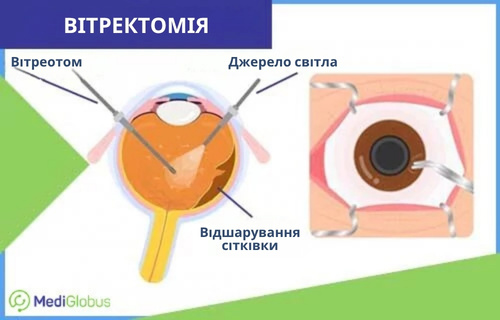 Інфографіка: Як проводиться вітректомія