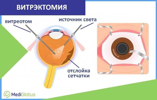 Что такое витрэктомия Инфографика: Как проводится витрэктомия