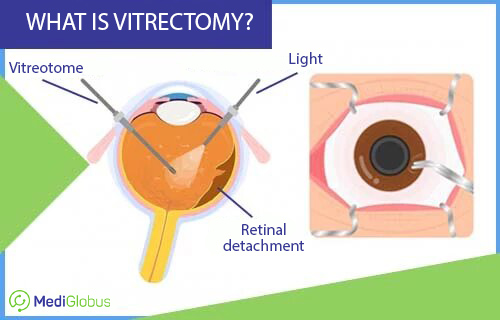 what is vitrectomy