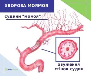 what_is_moyamoya_disease_ukr як виглядає звуження судин при хворобі моямо