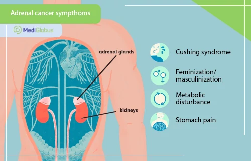 What is adrenal cancer and how is it treated? | MediGlobus