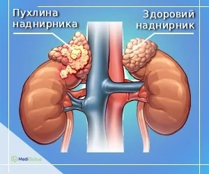 adrenocortical-tumor-what-is-it_ukr як виглядає пухлина наднирника