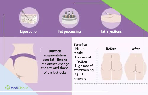 Buttock Implants Abroad - Intclinics