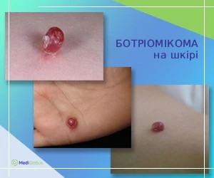 botryomycoma-on-the-skin_ukr Як виглядає ботріомікома на шкірі