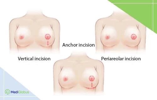breast reduction incisions