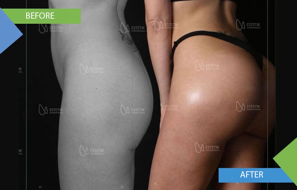 Butt Augmentation with Implants in Turkey - Aesthetic Travel