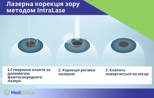 Як відбувається лазерна корекція зору IntraLase Інфографіка, що ілюструє 3 етапи лазерної корекції зору методом IntraLase: створення клаптика за допомогою фемтосекундного лазера, корекція рогівки та повернення клаптика на місце