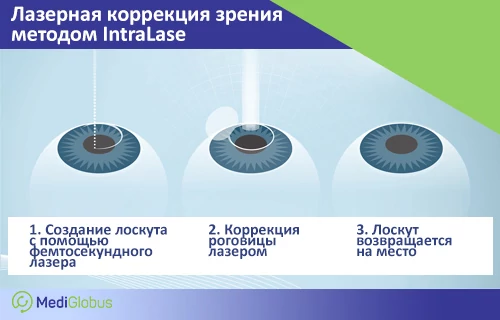 Как происходит лазерная коррекция зрения IntraLase Инфографика, показывающая 3 этапа лазерной коррекции зрения методом IntraLase: создание лоскута фемтосекундным лазером, коррекция роговицы и возвращение лоскута на место