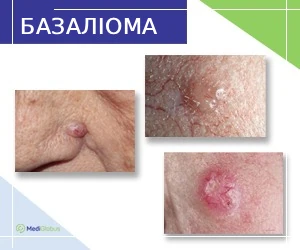 basal-cell-skin-cancer-basalioma_ukr Базаліома (рак шкіри) на обличчі