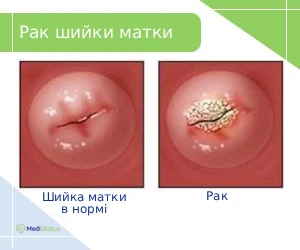 cervical-cancer_ukr Як виглядає рак шийки матки?