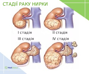 Стадії розвитку раку нирки: перша, друга, третя, четверта