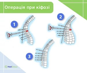 Surgery-for-kyphosis_ukr Методи хірургічного лікування кіфозу