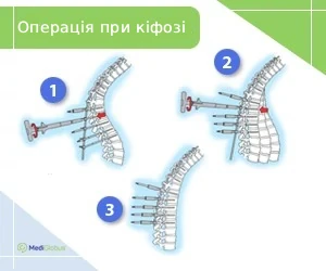 Surgery-for-kyphosis_ukr Методи хірургічного лікування кіфозу