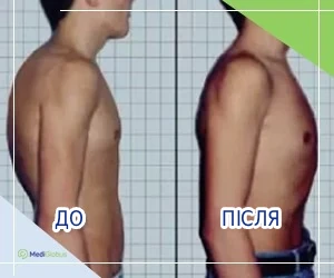 kyphosis-before-and-after_ukr Лікування кіфозу до та після