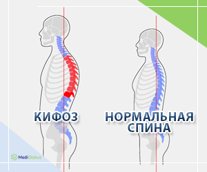 Врач рассказал, как лечить подростковую сутулость