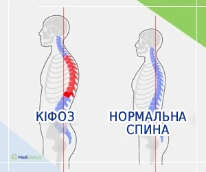 what-kyphosis-looks-like_ukr Порівняння здорової спини і кіфозу