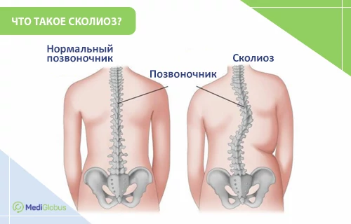Сколиоз - как лечить позвоночник